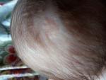 Лысое пятнышко на голове у малыша 2 мес фото 3
