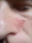 Шелушение кожи у носа фото 1