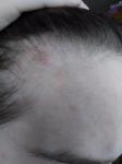 Зуд и шелушение красных пятен на волосистой части головы фото 4