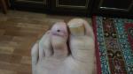 Воспаление после удаления ногтя на пальце ноги фото 1