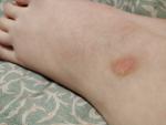 Пятно на ноге, не чешется, не изменяется в размере фото 1