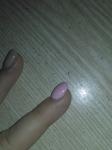 Водянистые пузырьки вокруг ногтя и на подушечках пальцев под ногтем фото 7