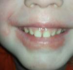 У ребёнка губы похожи на обветренные фото 2