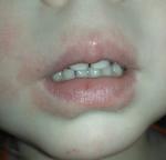 У ребёнка губы похожи на обветренные фото 1