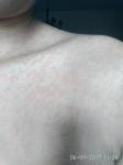 Опоясывающие высыпания на плечах и груди фото 1