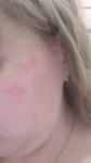 Аллергия кожные высыпания, зуд на лице фото 5