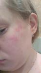 Аллергия кожные высыпания, зуд на лице фото 3