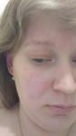 Аллергия кожные высыпания, зуд на лице фото 2