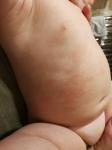 Сыпь на животе и подбородке у ребенка фото 4