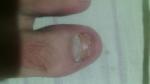 Проблемы с ногтем на ноге фото 2