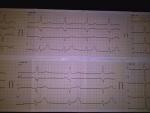 Пожалуйста помогите расшифровать кардиограмму не помогает лечение выписанными медикаментами фото 2