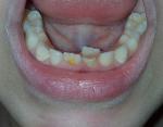 Желтое пятно на постоянном зубе ребенка фото 1