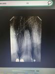 Абсцесс в зубе фото 1