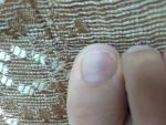 Темное пятно под ногтем большого пальца ноги фото 1