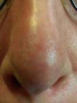 Красное пятно на кончике носа, увеличивается, жжет, Щиплет фото 1