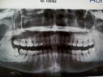 Зуб со штифтом болит фото 1