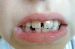 Пятна на коренных зубах у ребенка фото 3