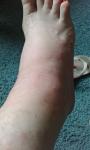 На коже ног болезненные высыпания и отёки фото 1