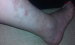На коже ног болезненные высыпания и отёки фото 2
