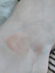 Сухие пятна коричневые на щиколодке ног при беременности фото 5