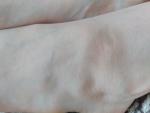 Сухие пятна коричневые на щиколодке ног при беременности фото 3