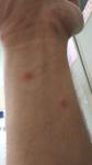 Появляются на руках и ногах прищики похожие на укусы комаров фото 2