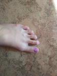 Молоткообразные пальцы ног фото 2
