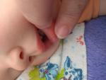 Язвочки во рту у ребенка фото 2