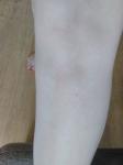 Сухое темное пятно на щиколотке ног фото 3