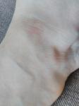 Сухое темное пятно на щиколотке ног фото 1