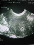 ХГЧ, полип, беременность фото 1