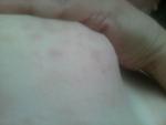Появилась сыпь, затем под грудью стали образовываться шелушащиеся пятна фото 2