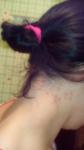 Болезненные прыщи на шее вдоль волос фото 1