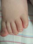 Полоски на ногтях ног у ребенка фото 2