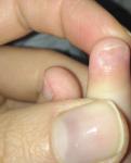 Полоски на ногтях ног у ребенка фото 1