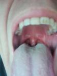 Проблема с горлом, припухла миндалина фото 1