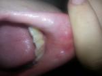 Красные пятна с внутренней стороны губы и больной зуб фото 1