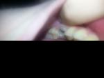 Красные пятна с внутренней стороны губы и больной зуб фото 2
