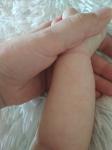Шелушащиеся пятна у грудного ребёнка фото 2