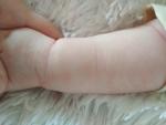 Шелушащиеся пятна у грудного ребёнка фото 1