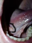 Небольшая болячка под языком. Что это может быть? фото 1
