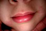Красные пятна вокруг уголков рта в виде маленьких пузыриков фото 1