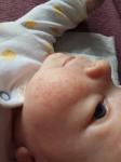 Сыпь у новорожденного: акне или аллергия фото 2