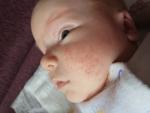 Сыпь у новорожденного: акне или аллергия фото 1