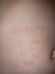 Красные пятна на теле у ребёнка, шершавые, чешутся фото 5
