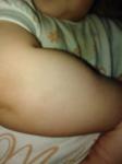 Белый ореол вокруг родимого пятна у ребенка фото 2