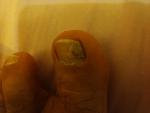 Отслоение ногтя большого пальца ноги фото 1