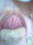 После курса антибиотиков при лечении фарингита горло ещё болит фото 1