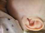 Мелкая сыпь у ребёнка 3 месяца фото 1