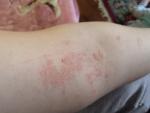 Сыпь на руке и выше фото 1